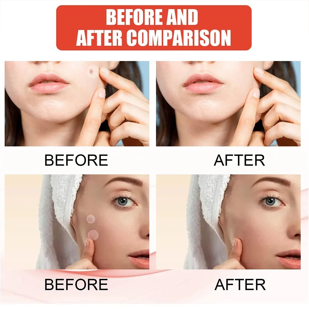 New Pimple Patch Acne Invisible Acne Removal Skin Care Stickers Concealer Face Spot Beauty Makeup Tools